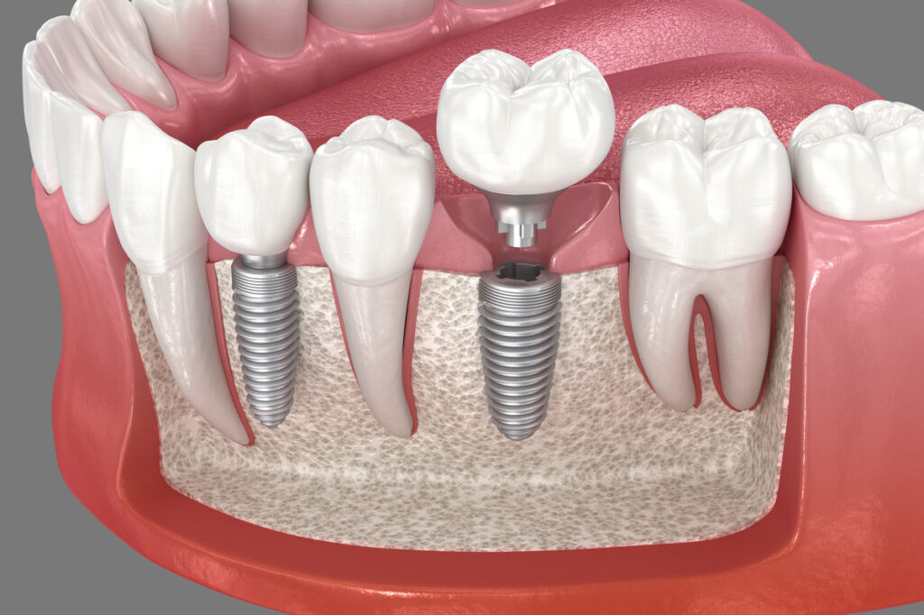 Premolar and Molar tooth implant installation. 3D illustration of dental treatment