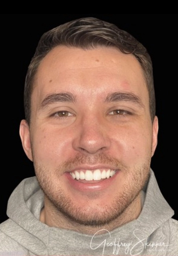 Boy After Dental Image