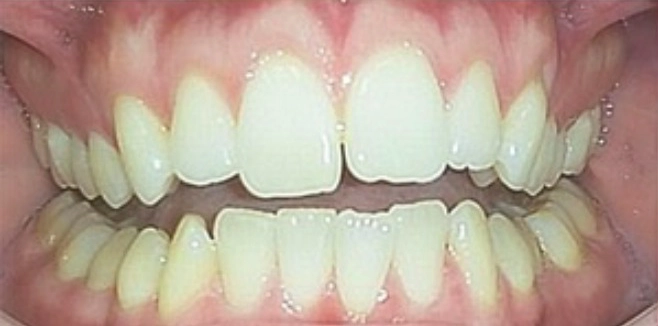 Dental Before