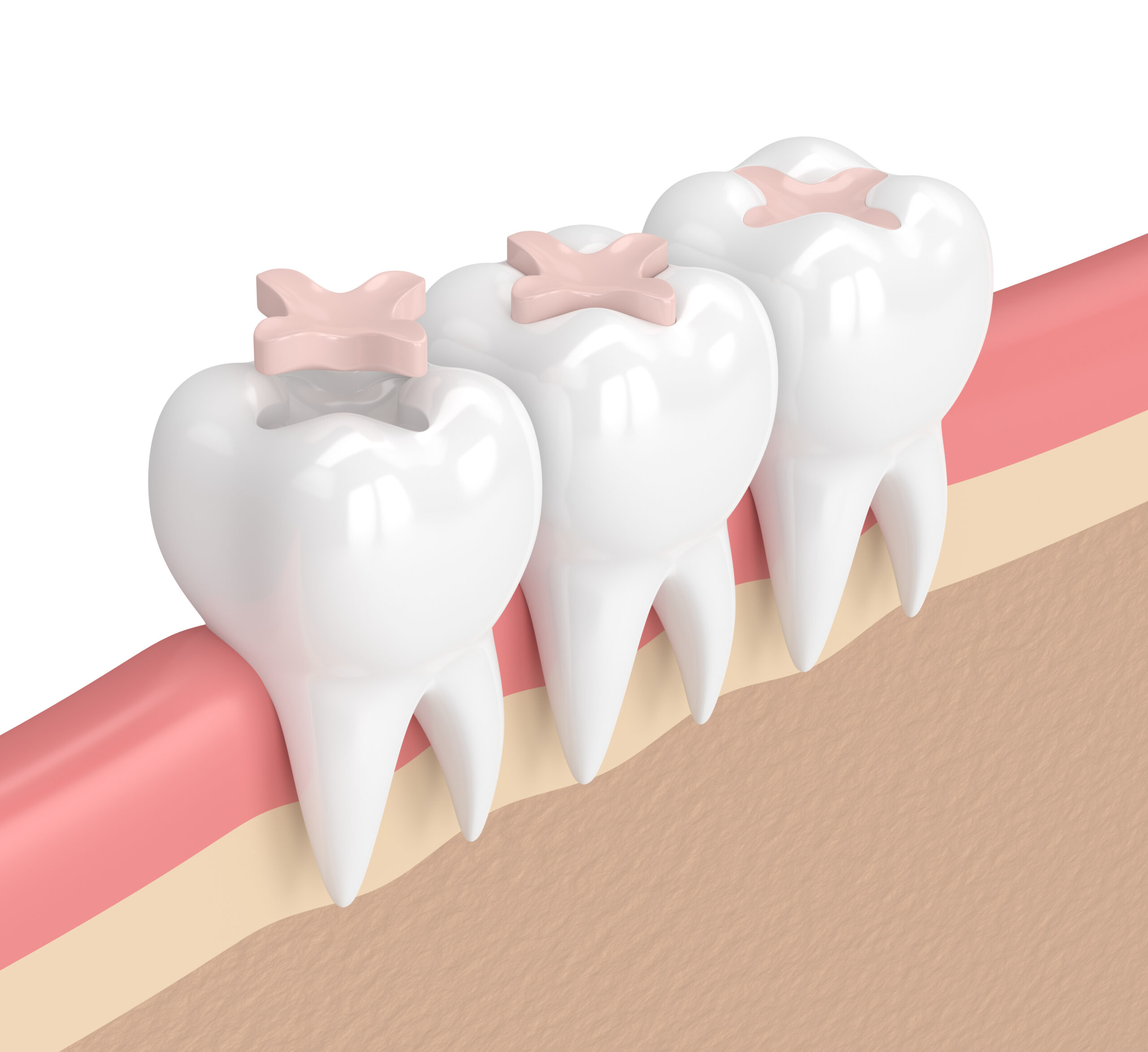 3d render of teeth with dental inlay filling in gums