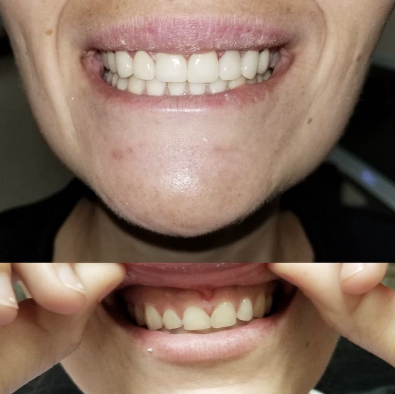 Before After 1