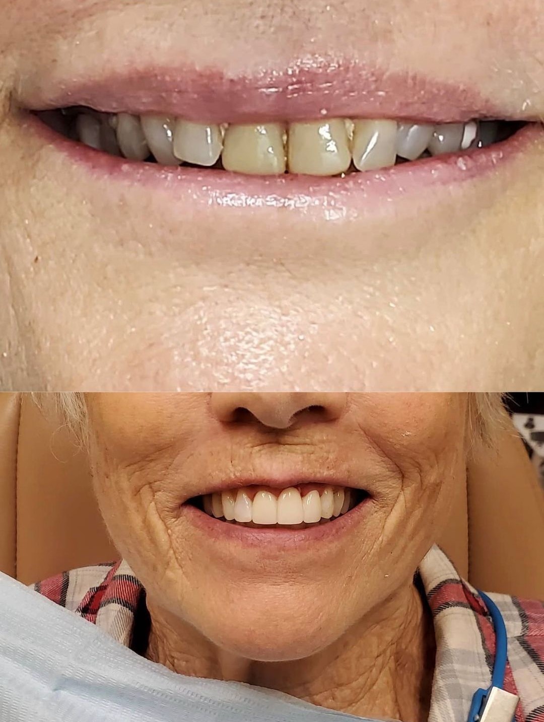 Smile Makeover